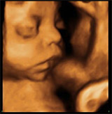 embarazo gemelar semana 32
