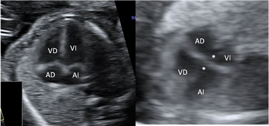 corazon con canal ventricular