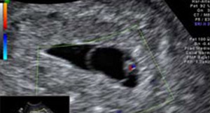 Ecografía Doppler de un embrión de 5 semanas