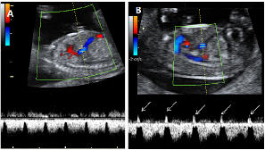flujo patológico en ecografía de la semana 12