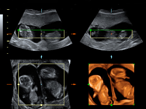 Ecografía gemelos con bolsas y placentas indepedientes