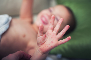 Cómo detectar y tratar la infección por sarampión en niños