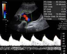 Ecografía doppler cordón umbilical