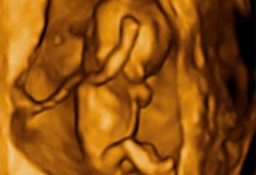 Ecografía 4D - feto de 12 semanas con cordón umbilical al hombro