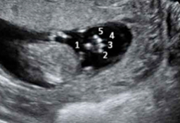 Ecografía Embarazo Semana 12 - dedos de una mano de un feto