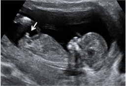 Ecografía 2D genitales de un feto varón - Semana 12