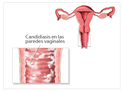 Candidiasis y cistitis en el embarazo