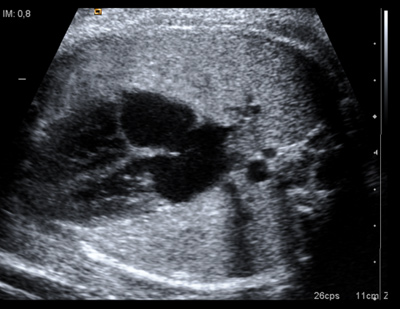 Como Se Llama El Medicamento Para Madurar Los Pulmones Del Bebe