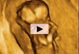 Ecografia De Un Bebe Con Cordon Umbilical Por El Brazo Natalben