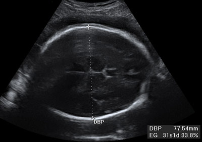 Ecografía de medición de diámetro biparietal