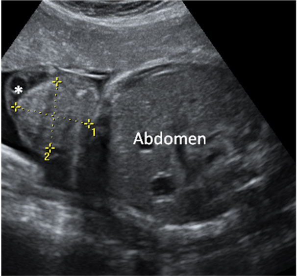 Ecografía del abdomen fetal con onfalocele