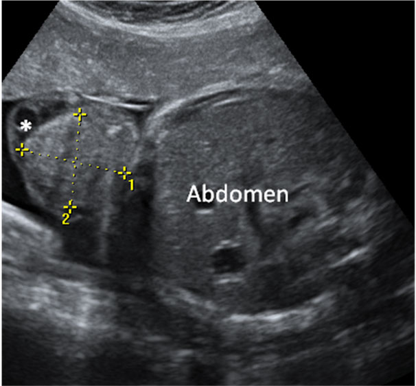 Ecografía del abdomen fetal con onfalocele	