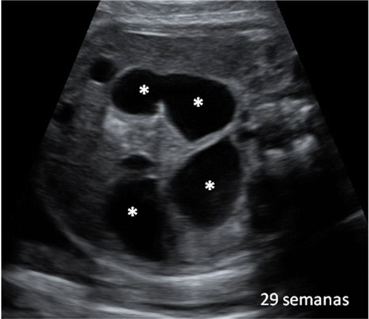 Ecografía: Dilatación de asas intestinales