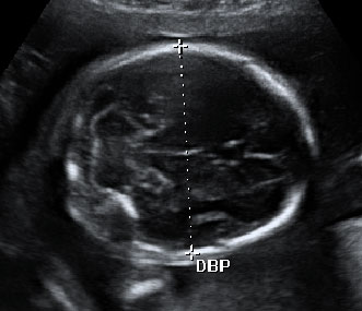 Ecografía semana 20: medición diámetro biparietal