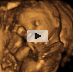 Ecografía de cara de bebé con 18 semanas de gestación