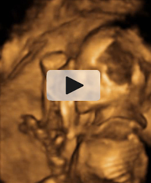Ecografía de los brazos de un feto de 20 semanas