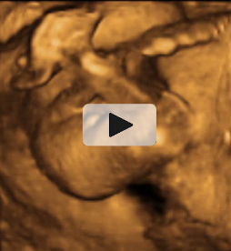 Ecografía semana 20: sexo fetal niño en 3D