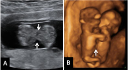 Siameses: ecografía de fetos unidos por el abdomen