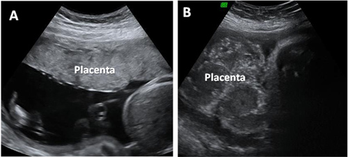 placenta primer trimestre