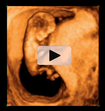 Ecografía en 4D de feto de 11 semanas