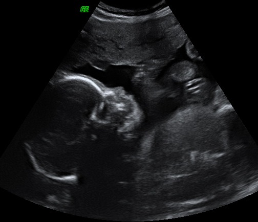 Feto semana 17 de embarazo: cabeza y perfil