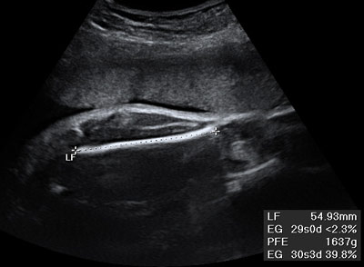 tercer trimestre femur