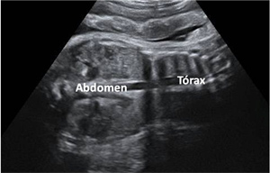 abdomen torax