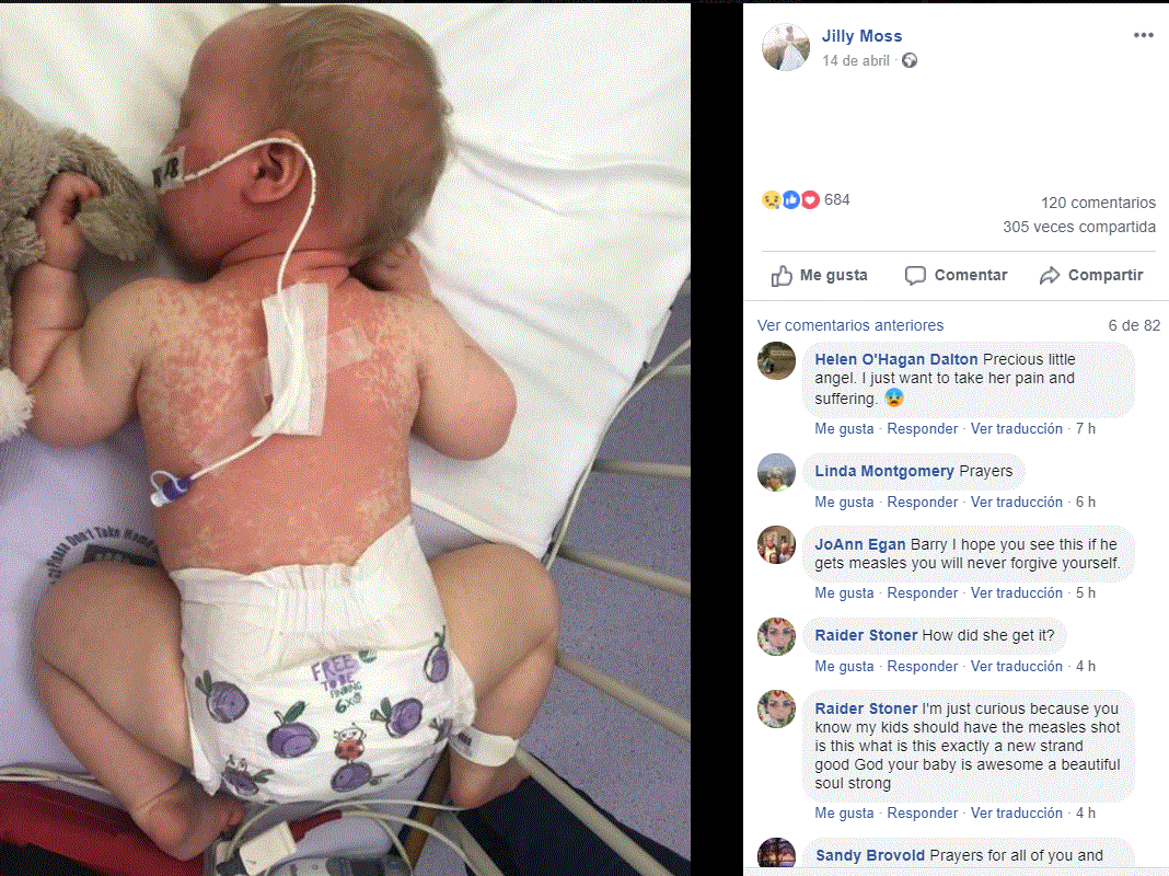 Imágenes de lactante con sarampión compartida en facebook