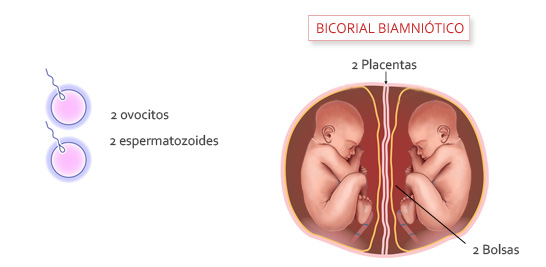 Bicorial biamniótico