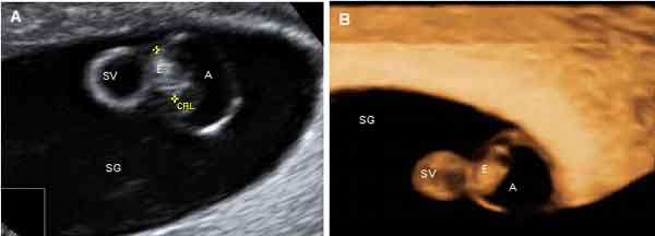 Doppler Fetal Para Escuchar En Un Latido Del Corazón De La Mujer Embarazada  De Un Niño Y De Una Imagen De Un Ultrasonido Del Emba Foto de archivo -  Imagen de escuche