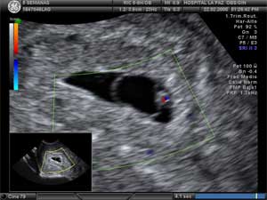 ecografia de 2 semanas