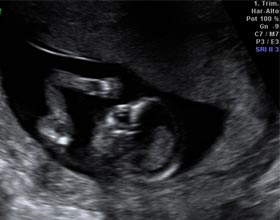 Feto semana 13 de embarazo