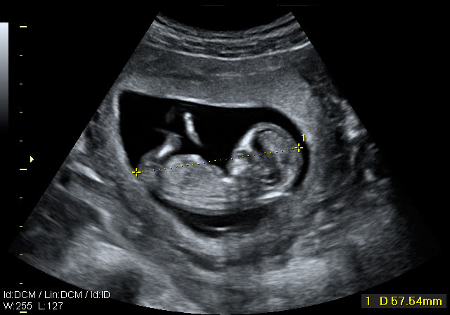 Ecografía bidimensional de un feto de 12 semanas