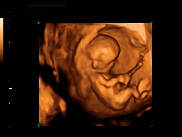 Ecografía en 3D de un feto de 12 semanas