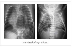 Hernia diafragmática en el feto