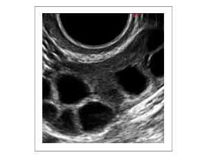folículos ováricos por ecografía
