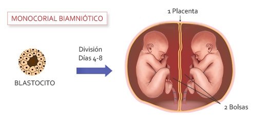 Monocorial biamniótico