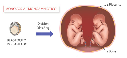 Monocorial monoamniótico