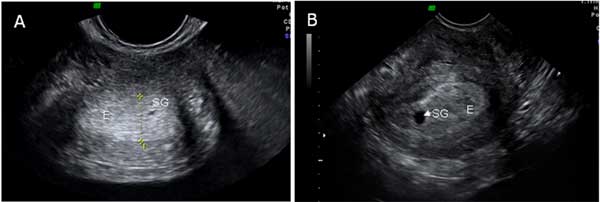 Como Se Ve Un Bebe De 3 Meses De Gestacion