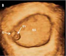 Semana 5 de embarazo ecografía embrión