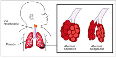 alveolos normales y colapsados