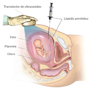 Amniocentesis: qué es y cómo se realiza