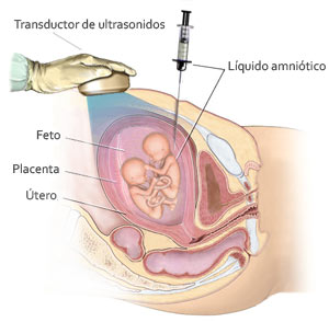 amniocentesis 