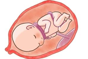 Mi bebé viene con vuelta de cordón umbilical