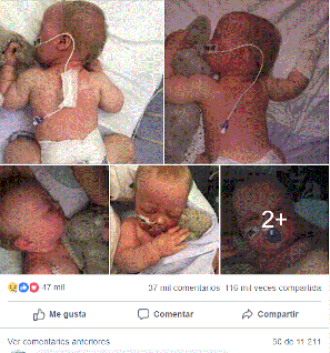 Brotes de sarampión se triplican: bebé con sarampión en Facebook