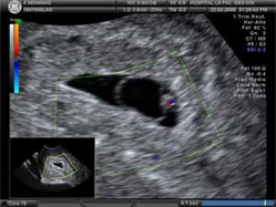 ecografia doppler embrion 5 semanas