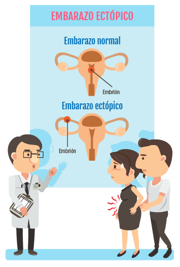 Gestación ectópicas, señales: dolor y hemorragia fuerte