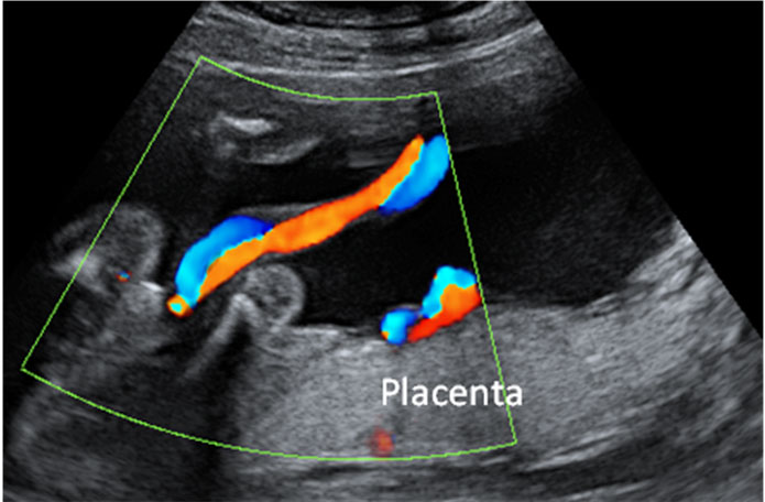 Cordón umbilical visto con ecografía Doppler color