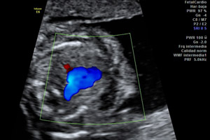 Ecografia doppler semana 18