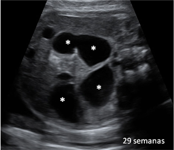 Obstrucción intestinal en feto de 20 semanas